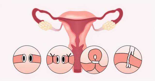什么是输卵管复通术？复通后怀孕的几率大吗？